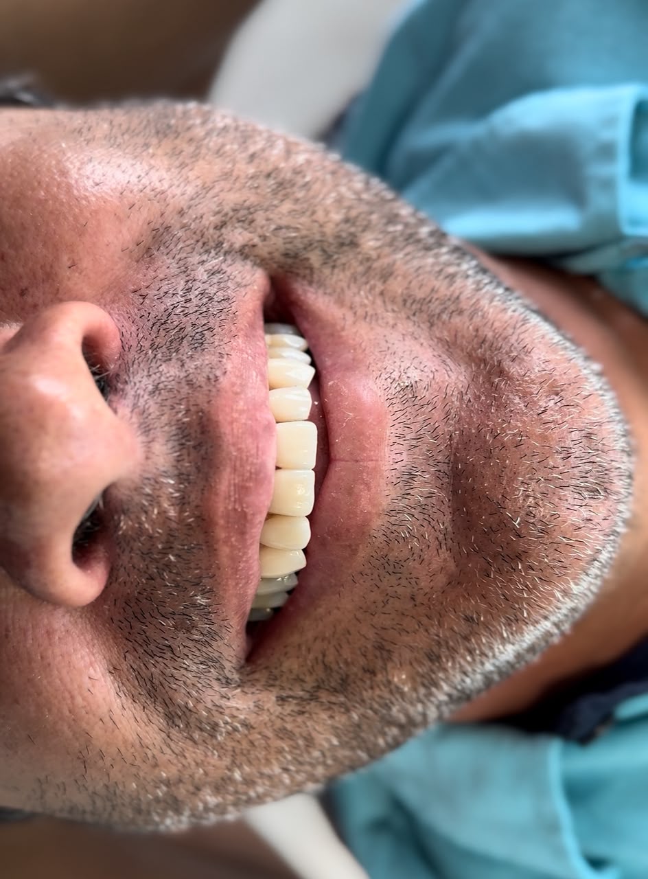 Sorriso do mesmo paciente após o tratamento reabilitador